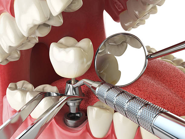 Best Lost Filling or Crown Replacement in Short Hills, NJ